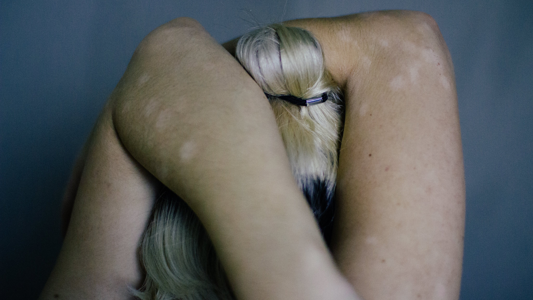 How a controversial diet helped one woman combat her chronic skin condition